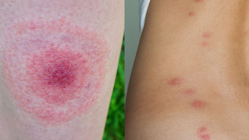 Эфирное масло ветивера помогает заживлять раны, сыпь и укусы насекомых.